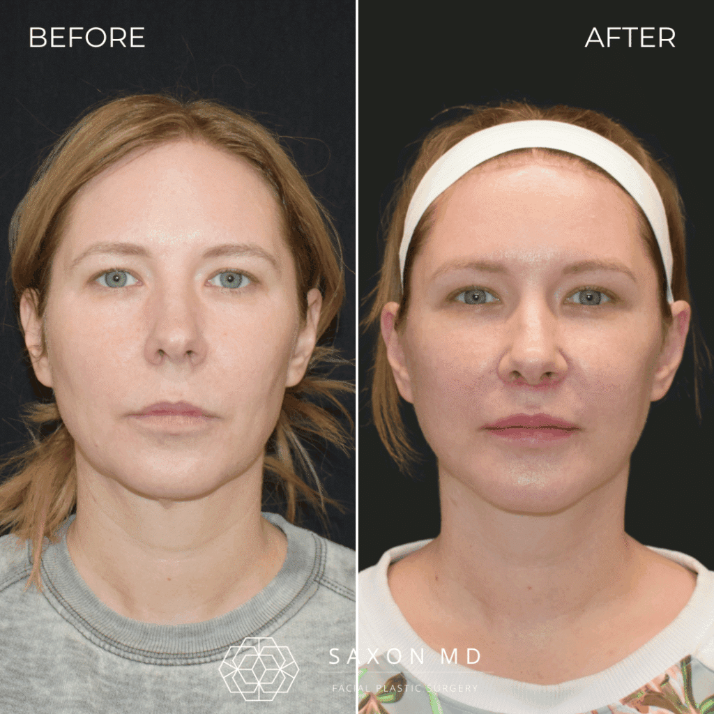 deep plane facelift before and after; facelift austin; facelift dallas