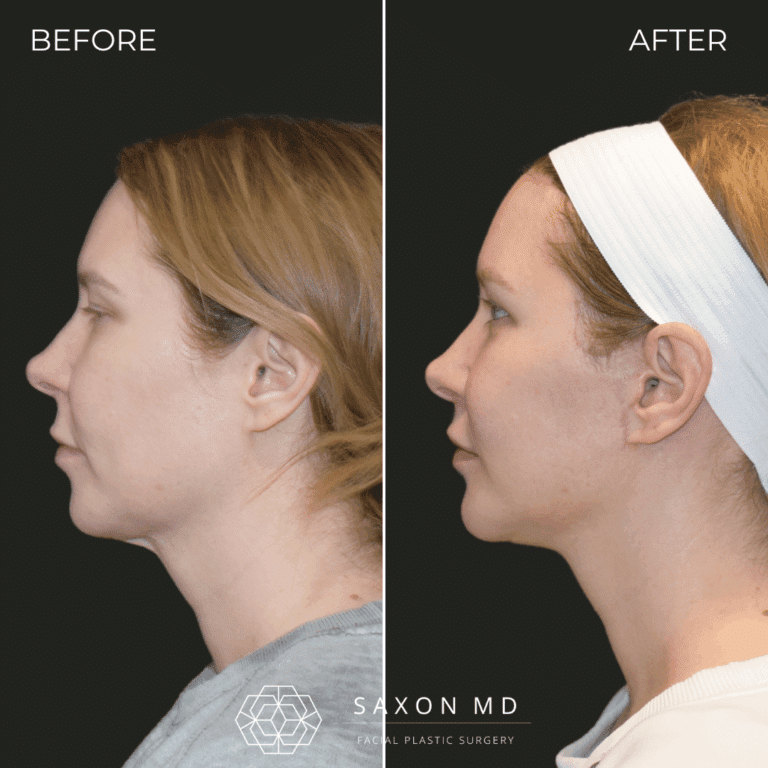 Before and after deep plane facelift, side profile, by Austin facial plastic surgeon Dr. Sarah Saxon