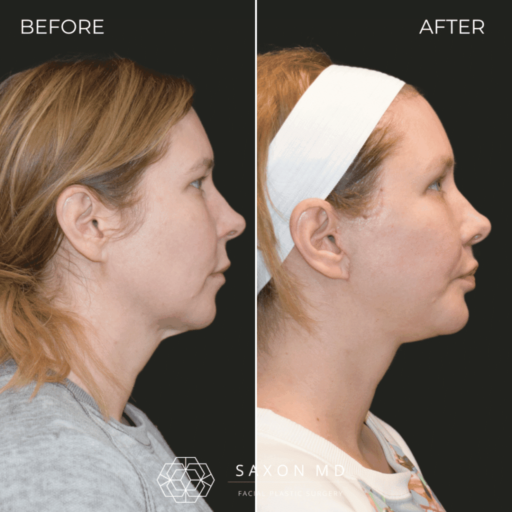 deep plane facelift before and after; facelift austin; facelift dallas