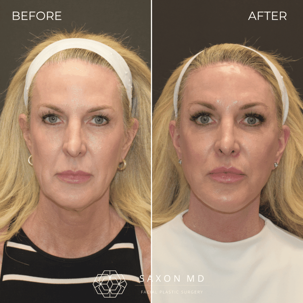 deep plane facelift before and after; facelift austin; facelift dallas