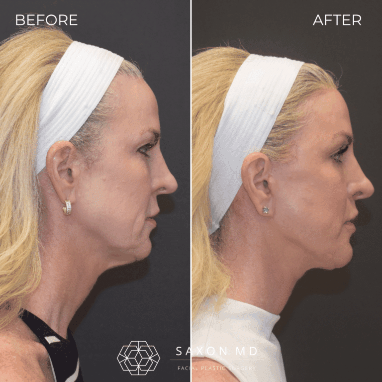 Before and after deep plane facelift, side profile, by Austin facial plastic surgeon Dr. Sarah Saxon