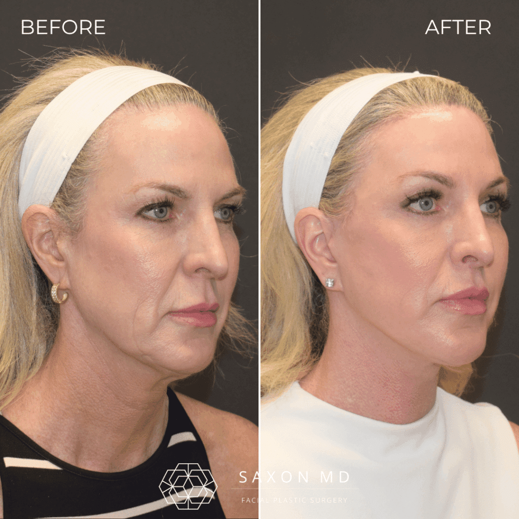 deep plane facelift before and after; facelift austin; facelift dallas
