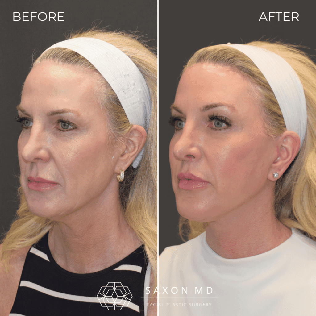 deep plane facelift before and after; facelift austin; facelift dallas
