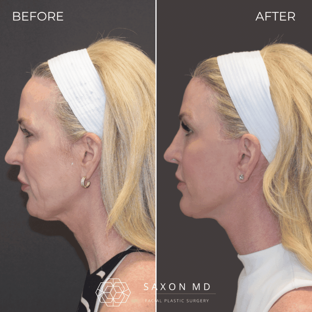 deep plane facelift before and after; facelift austin; facelift dallas