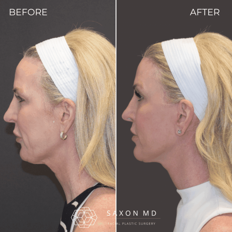 Before and after deep plane facelift, side profile, by Austin facial plastic surgeon Dr. Sarah Saxon
