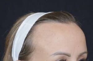 big forehead