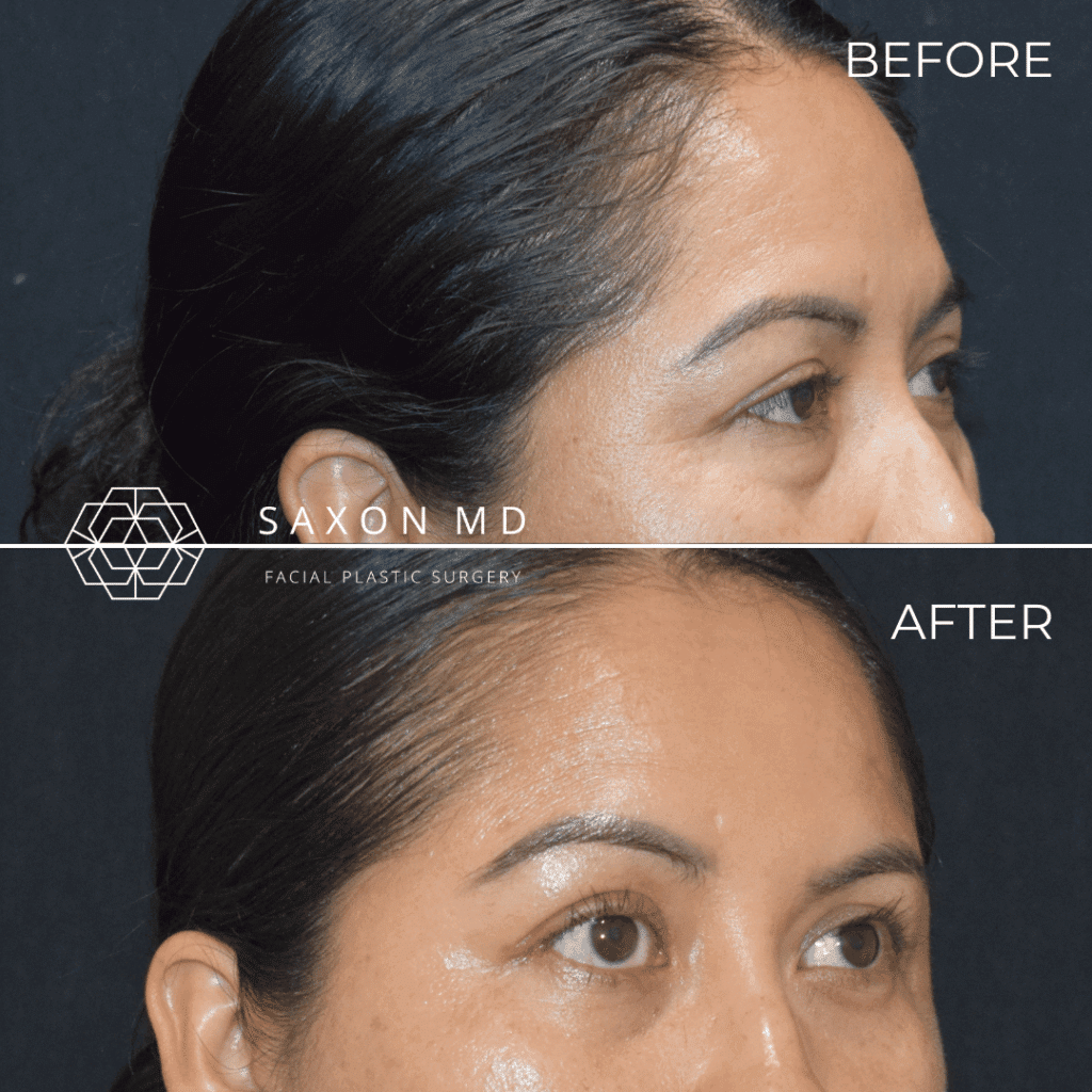 Blepharoplasty 23 blepharoplasty before and after; blepharoplasty austin; blepharoplasty dallas