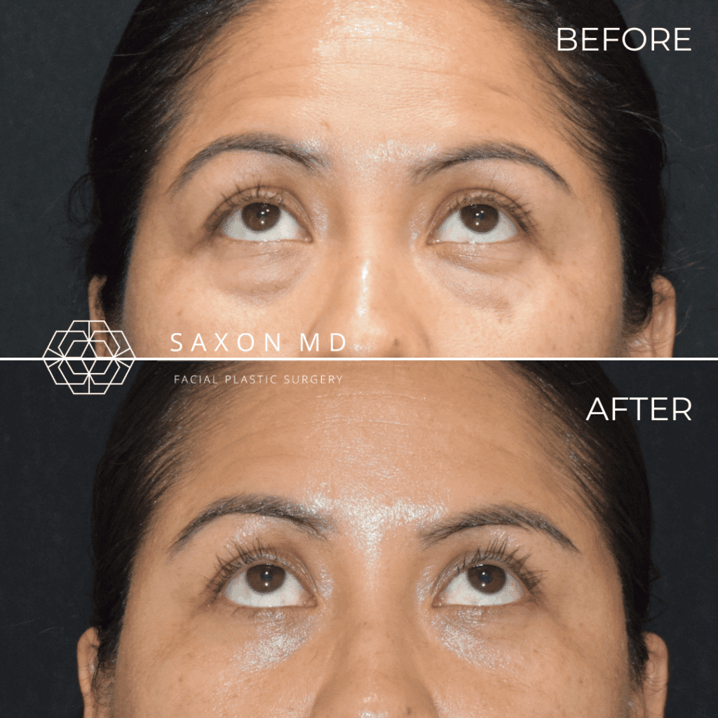 Blepharoplasty 22 blepharoplasty before and after; blepharoplasty austin; blepharoplasty dallas