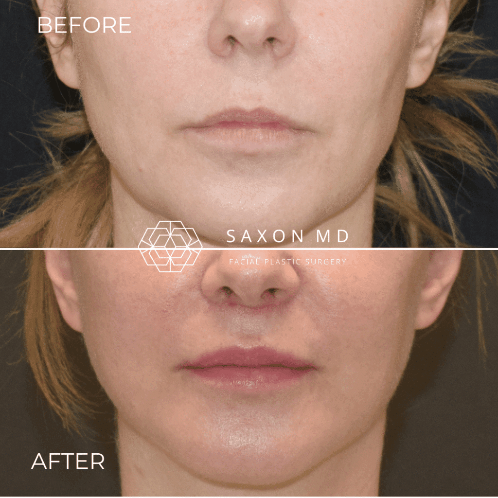 lip lift before and after