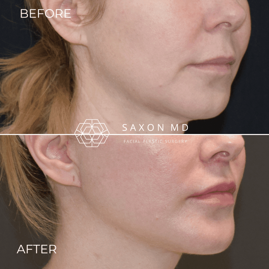 lip lift before and after