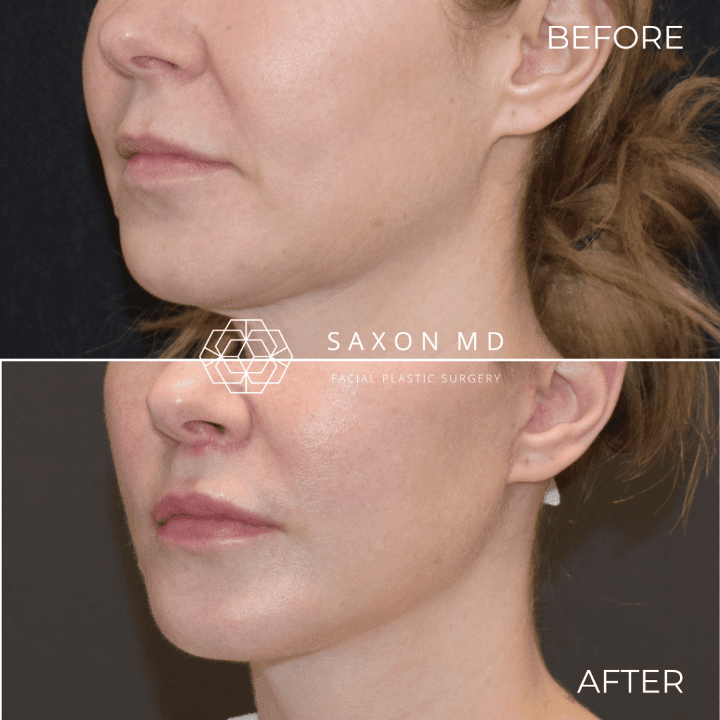 lip lift before and after