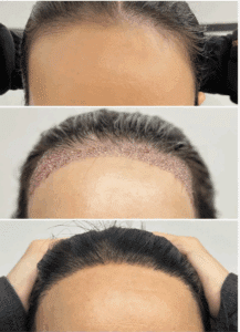 forehead reduction vs hair transplant