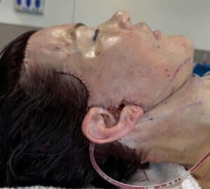 preservation deep plane facelift