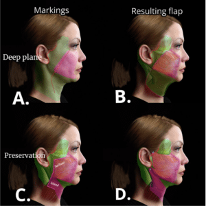 preservation deep plane facelift