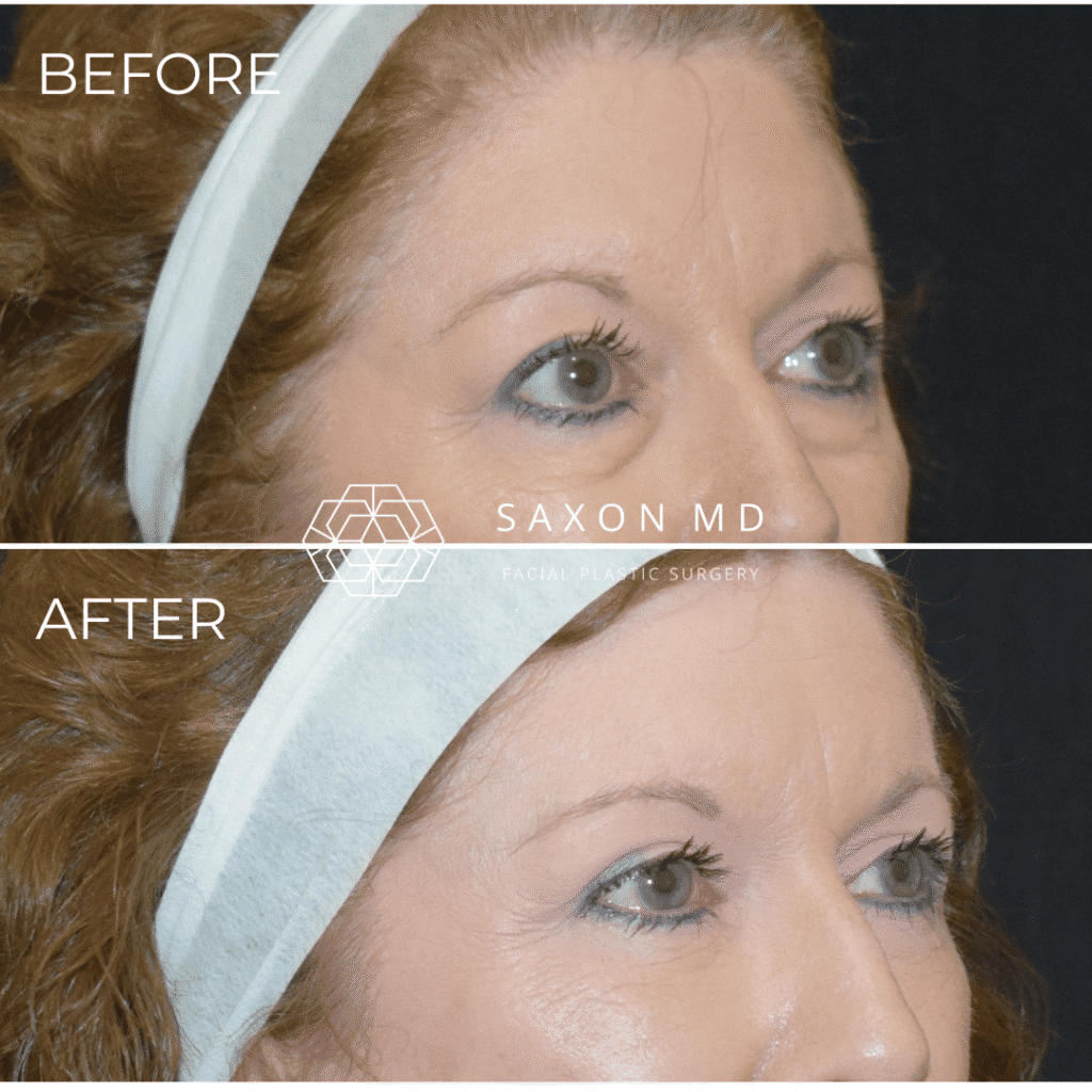 blepharoplasty before and after - Dr. Sarah Saxon Austin, TX