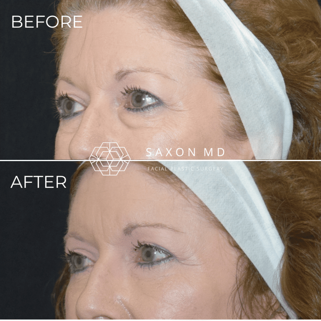 blepharoplasty before and after - Dr. Sarah Saxon Austin, TX