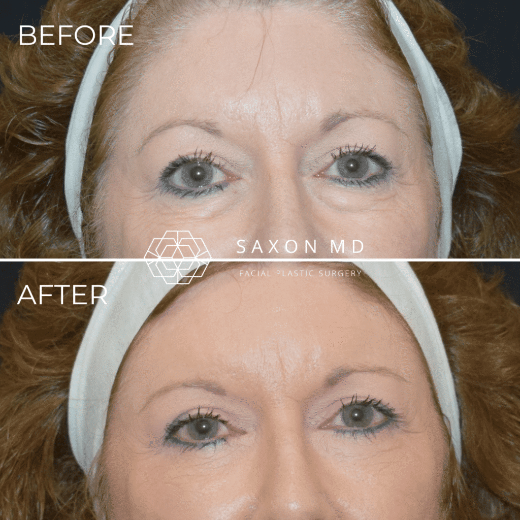 blepharoplasty before and after - Dr. Sarah Saxon Austin, TX