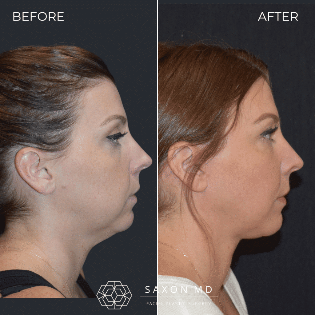 before and after; deep plane facelift austin; facelift austin; facelift austin tx