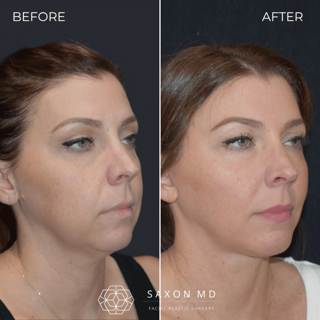 before and after; deep plane facelift austin; facelift austin; facelift austin tx