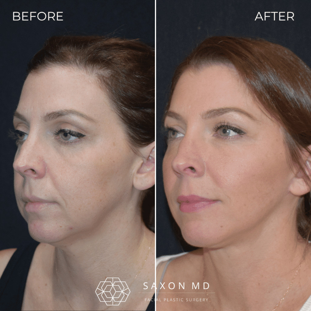 deep plane facelift before and after; deep plane facelift austin; facelift austin; facelift austin tx