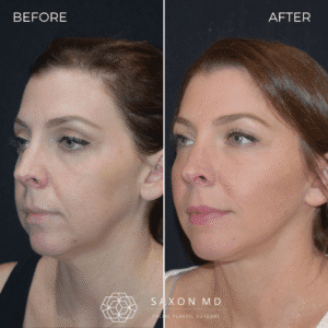 How Long Does a Deep Plane Facelift Last? 2 deep plane facelift before and after; deep plane facelift austin; facelift austin; facelift austin tx; how long does deep plane facelift last