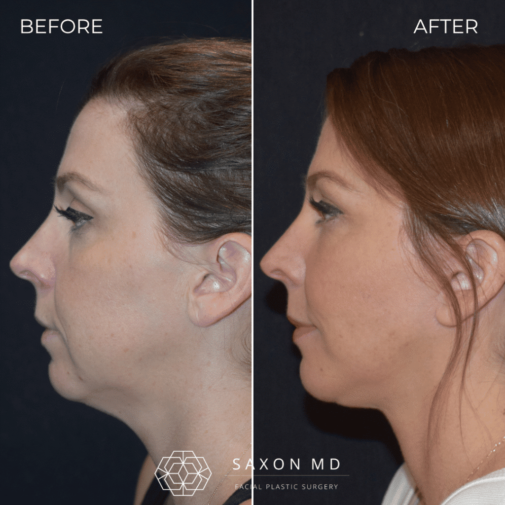 before and after; deep plane facelift austin; facelift austin; facelift austin tx