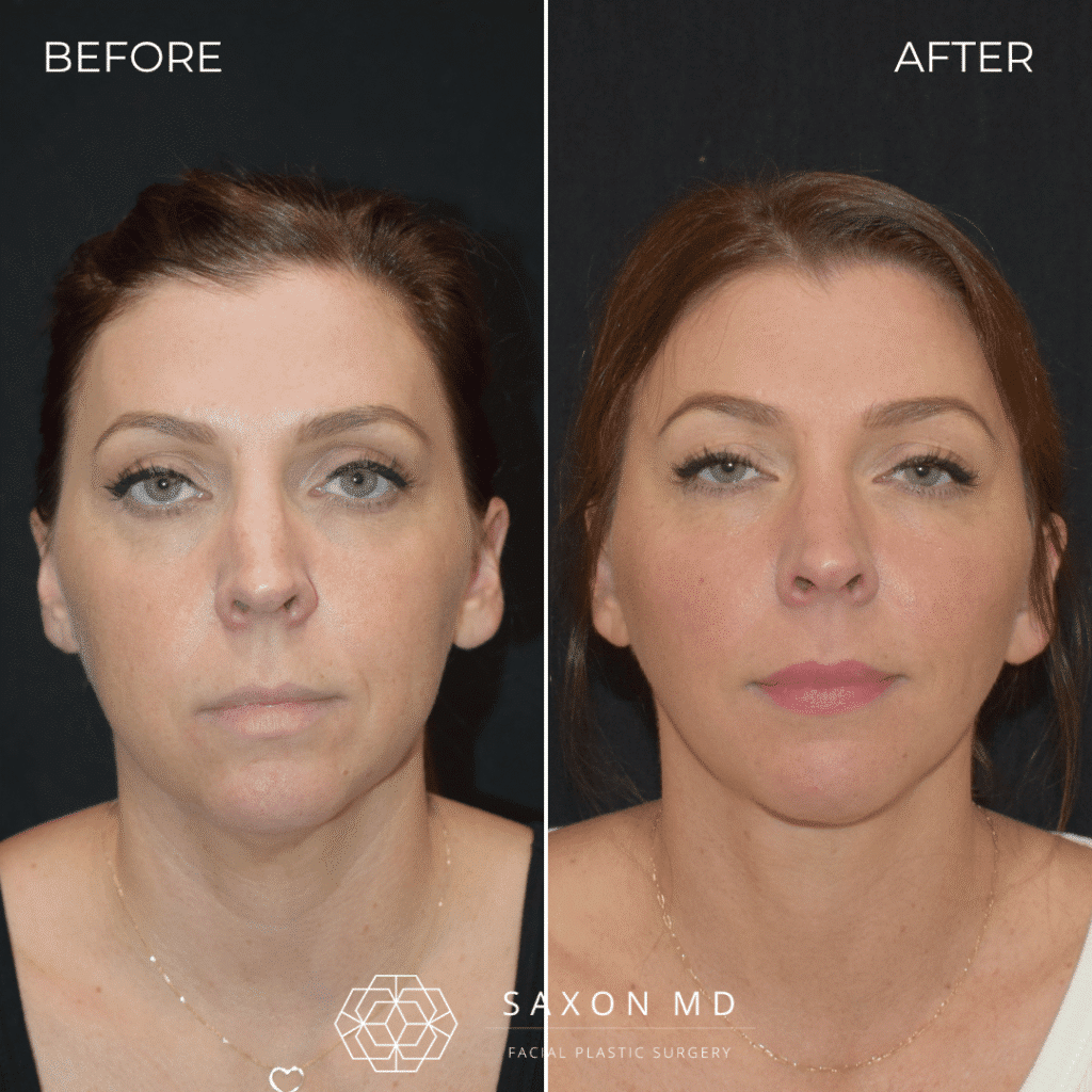 before and after; deep plane facelift austin; facelift austin; facelift austin tx