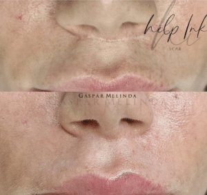 Lip lift scar, medical tattooing, micropigmentation