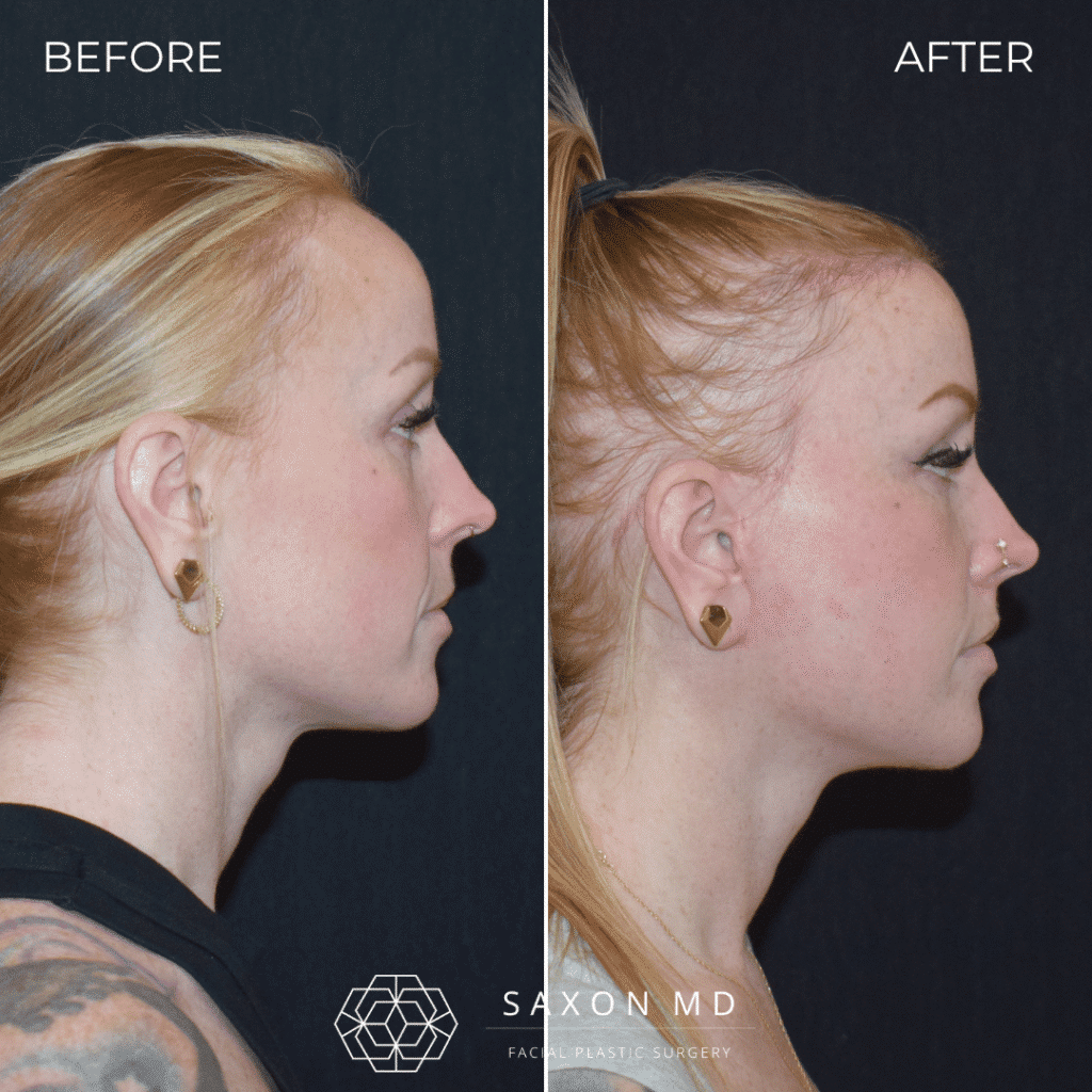 deep plane facelift before and after; facelift before and after; facelift austin; facelift austin tx