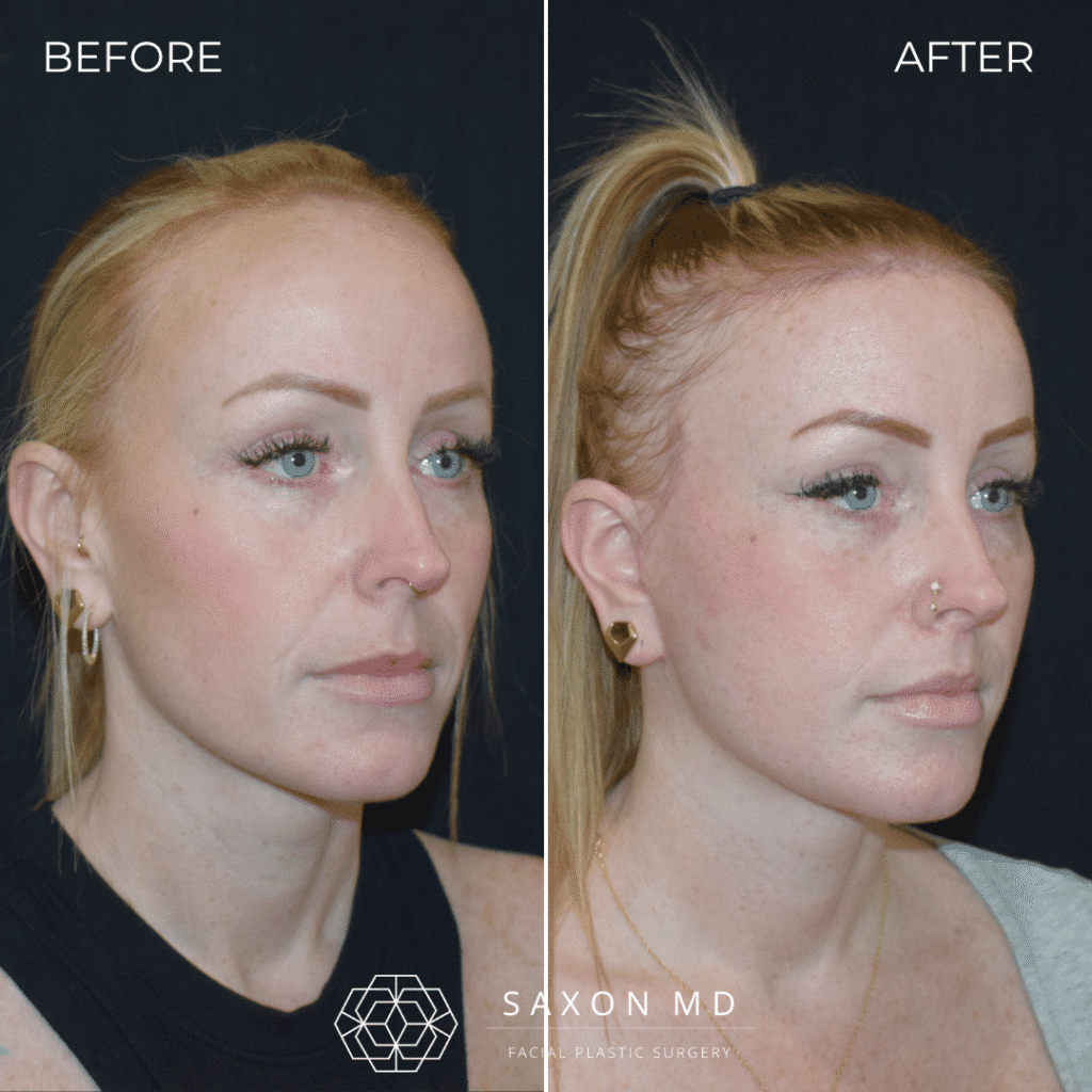 deep plane facelift before and after; facelift before and after; facelift austin; facelift austin tx