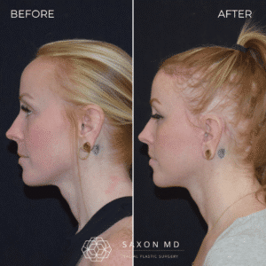 deep plane facelift before and after; facelift before and after; facelift austin; facelift austin tx; hairline lowering surgery recovery