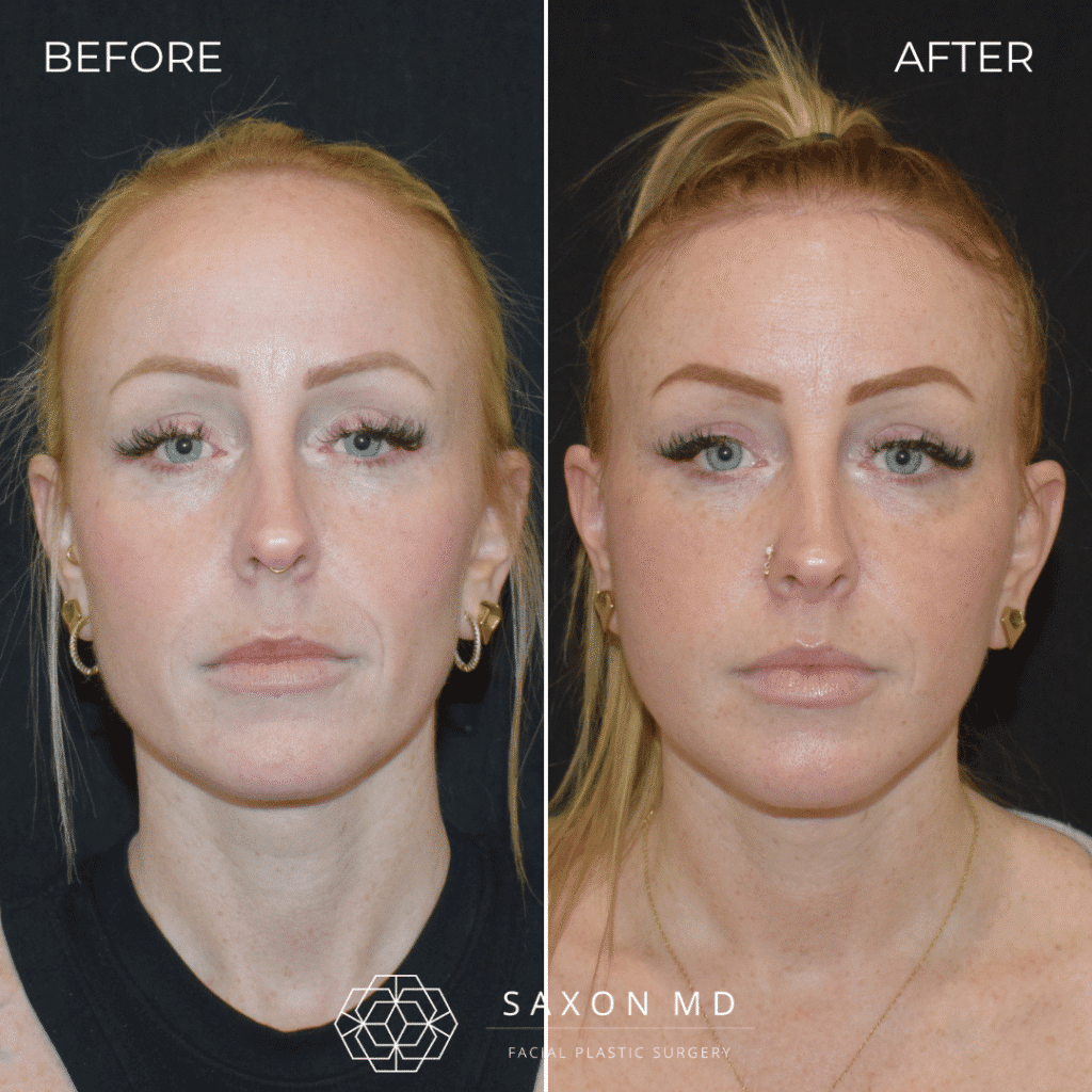 deep plane facelift before and after; facelift before and after; facelift austin; facelift austin tx