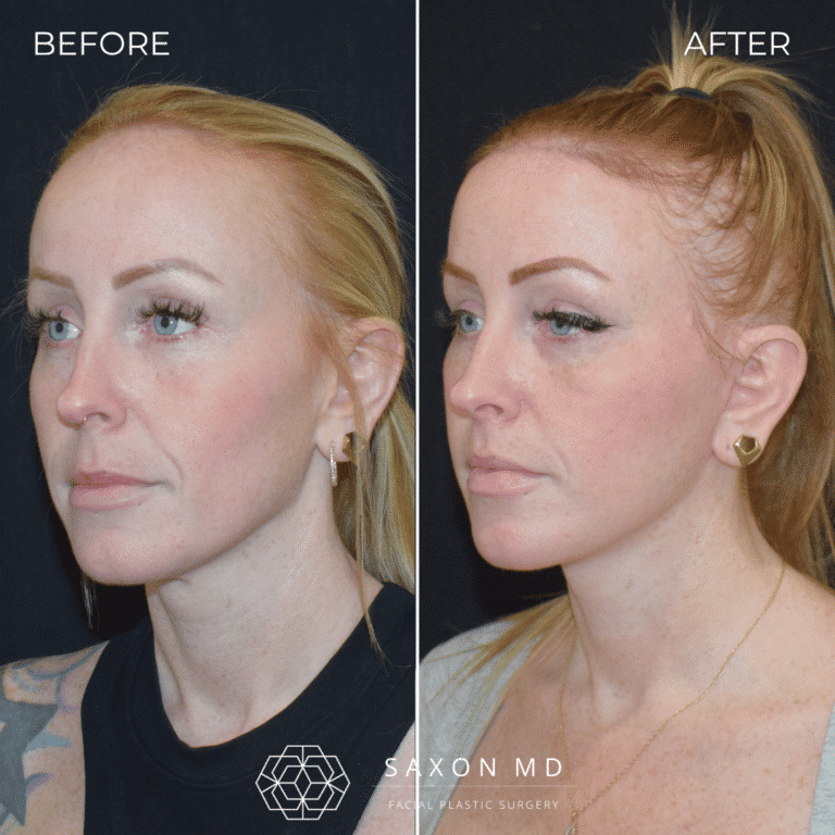 Before and after deep plane facelift, three quarter view, by Austin facial plastic surgeon Dr. Sarah Saxon