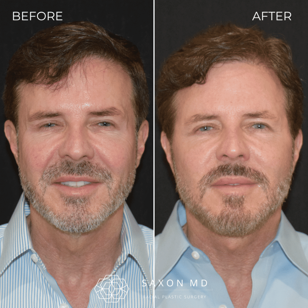 deep plane facelift before and after; deep plane facelift austin; deep plane facelift dallas; male facelift