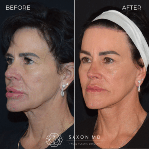 How Long Does a Deep Plane Facelift Last? 1 deep plane facelift austin; deep plane facelift dallas; facelift austin; how long does deep plane facelift last