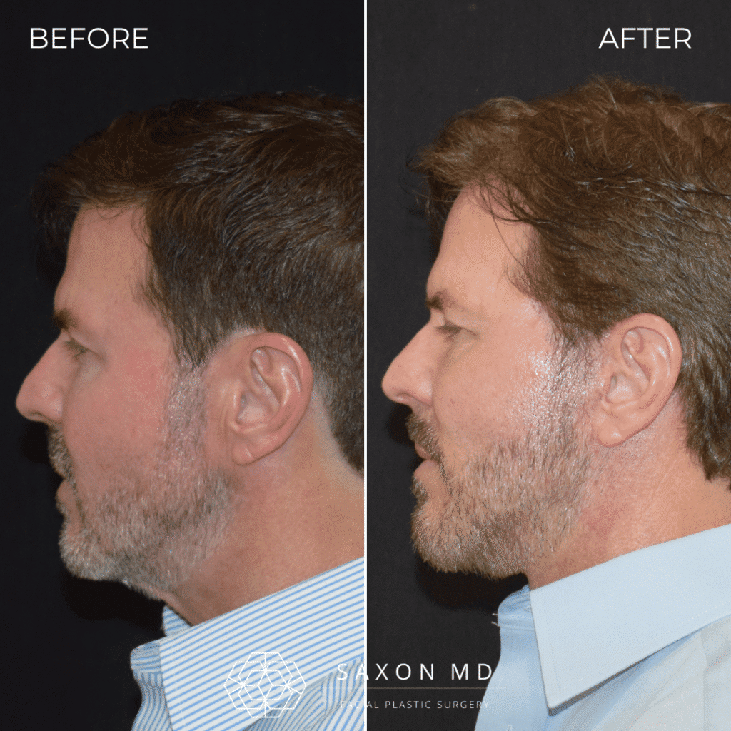 deep plane facelift before and after; deep plane facelift Austin; deep plane facelift Dallas; male facelift