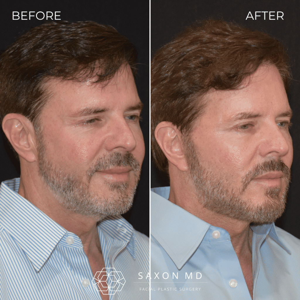 deep plane facelift before and after; deep plane facelift austin; deep plane facelift dallas; male facelift