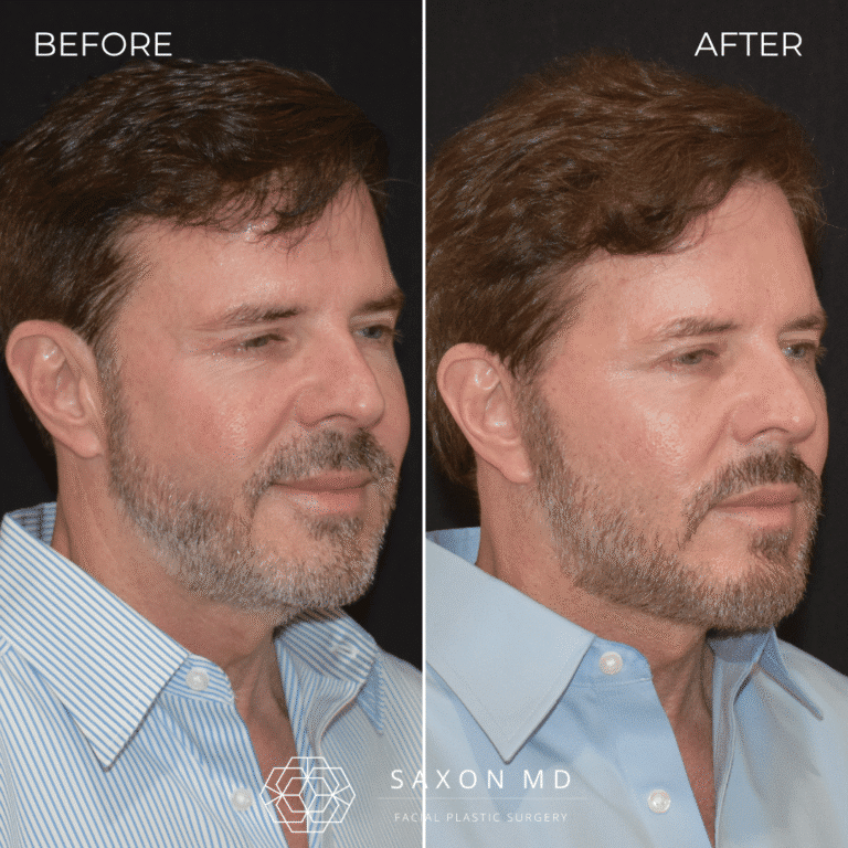 Before and after male deep plane facelift, three quarter view, by Austin facial plastic surgeon Dr. Sarah Saxon