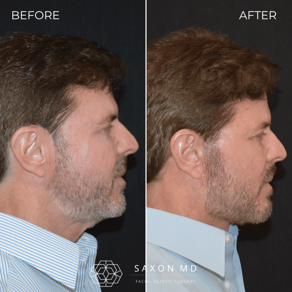 deep plane facelift before and after; deep plane facelift austin; deep plane facelift dallas; male facelift