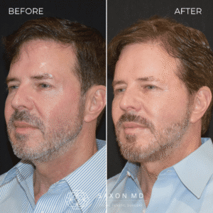How Long Does a Deep Plane Facelift Last? 4 deep plane facelift austin; deep plane facelift dallas; deep plane facelift in men; how long does deep plane facelift last