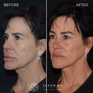 deep plane vs smas facelift