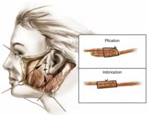 Deep Plane vs SMAS Facelift: What's the Difference? 2 deep plane vs smas facelift